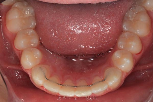 western-ortho-bonded-retainer